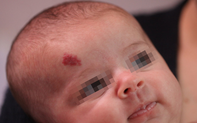 La cura per gli emangiomi infantili: il propranololo