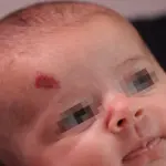 La cura per gli emangiomi infantili: il propranololo