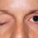 Malattie croniche: miastenia grave, sintomi e diagnosi