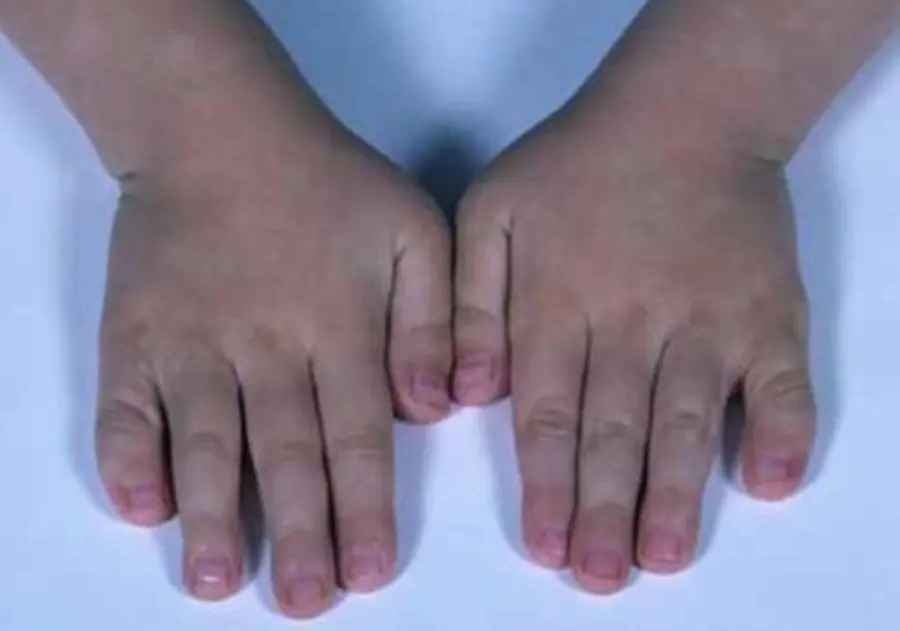 Sindrome di Aarskog-Scott: diagnosi, si può curare?