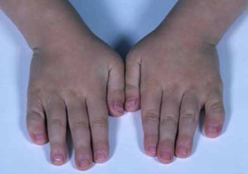 Sindrome di Aarskog-Scott: diagnosi, si può curare?