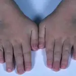 Sindrome di Aarskog-Scott: diagnosi, si può curare?