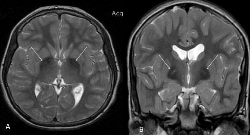 Malattie rare: aceruloplasminemia, cos'è e quali sono i sintomi