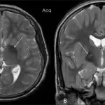 Malattie rare: aceruloplasminemia, cos'è e quali sono i sintomi