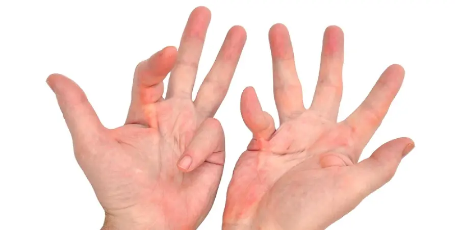 Che cos'è il morbo di Dupuytren? primi segni e come si cura
