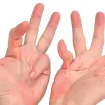 Che cos'è il morbo di Dupuytren? primi segni e come si cura