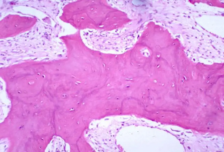 Morbo di Paget: cos'è, diagnosi e cura della malattia ossea