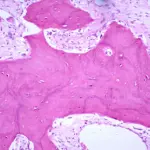 Morbo di Paget: cos'è, diagnosi e cura della malattia ossea