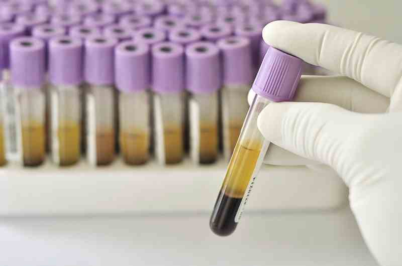 Ematocrito Basso cos'è e da cosa dipende? Info e sintomi