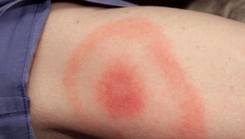 Malattia di Lyme: diagnosi, sintomi e come curarla