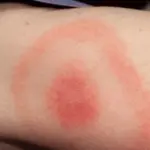 Malattia di Lyme: diagnosi, sintomi e come curarla