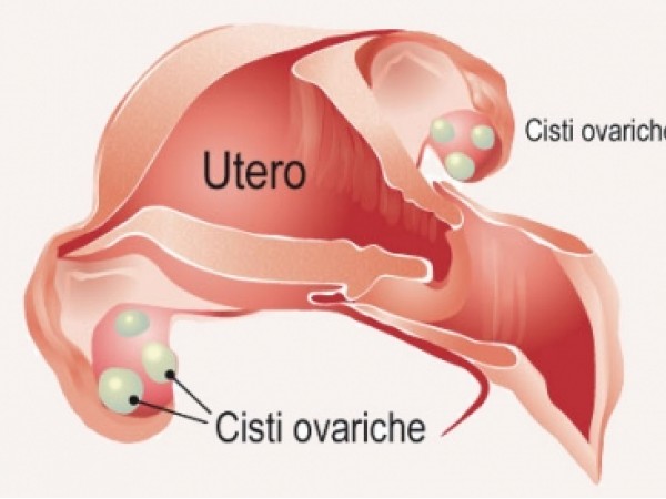 Cisti ovarica, cosa è e quali sono i sintomi e le cure