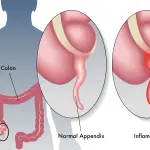 Appendicite cos'è e come prevenirla
