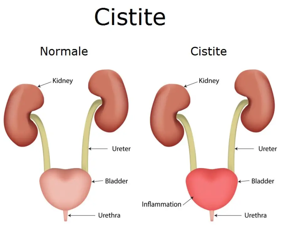 Cistite: cos'è, cause e rimedi naturali