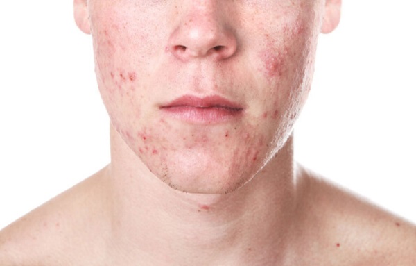 Acne: cos'è e quali sono le terapie migliori?